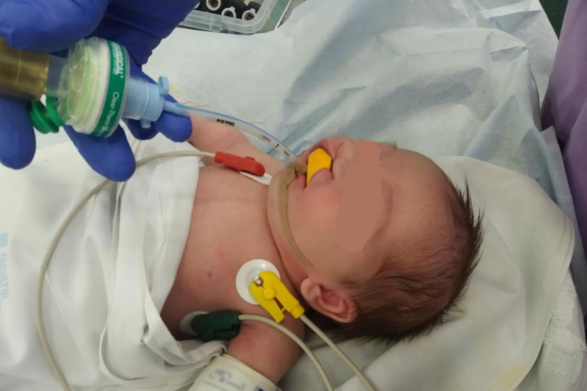 Nová intubační pomůcka pro děti s rozštěpem